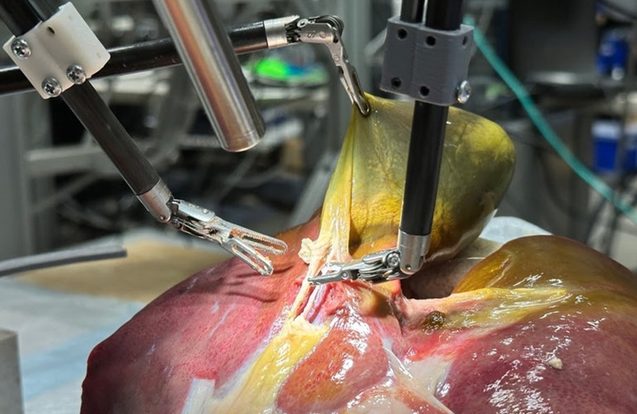A Robot Performs the First Gallbladder Surgery Without Manual Human Intervention